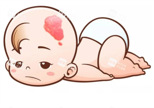 新生儿鲜红斑痣