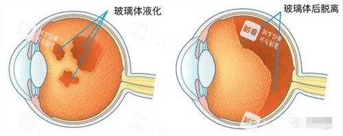 玻璃体问题图片