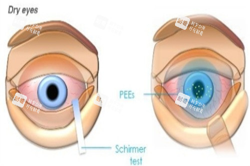 干眼检查
