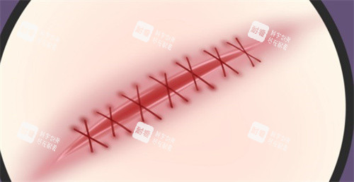 手术疤痕 手术疤痕