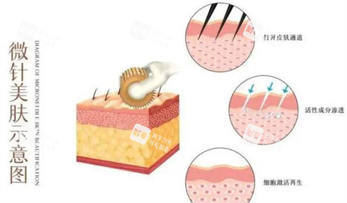 微针美肤 微针美肤