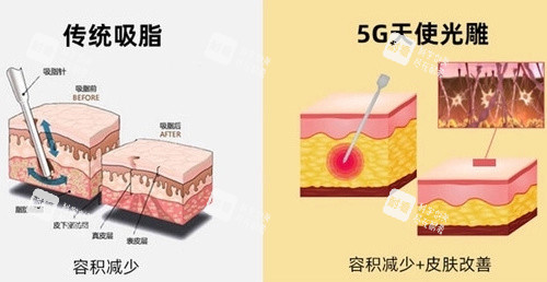 5G天使光雕对比传统吸脂 5G天使光雕对比传统吸脂