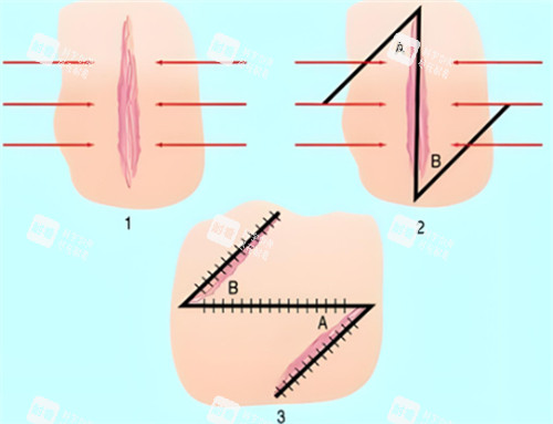 z字成型法 z字成型法