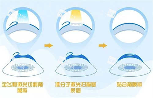 飞秒激光手术过程