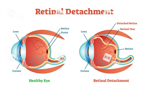 视网膜劈裂对比图 视网膜劈裂对比图