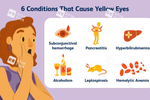 造成眼睛发黄的原因