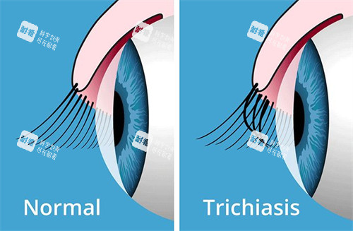 正常睫毛和倒睫