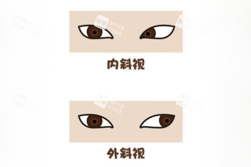 眼睛内斜视和外斜视卡通对比图