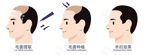 毛囊移植术前术后成效动画图