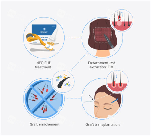 微针植发的过程图解