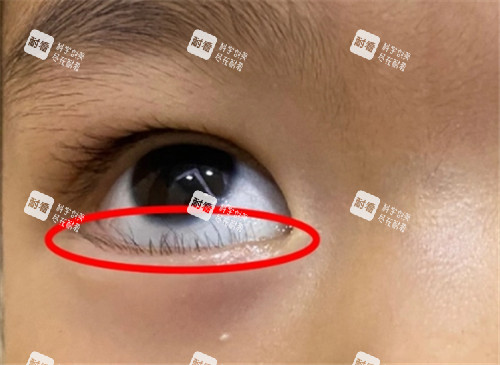 睑内翻倒睫照片