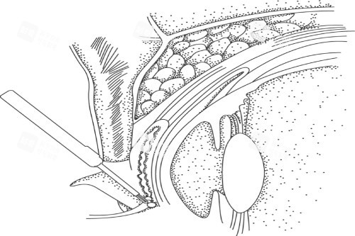 倒睫手术示意图