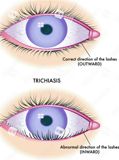 正常的睫毛和倒睫的睫毛