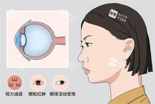 甲亢突眼的危害图解