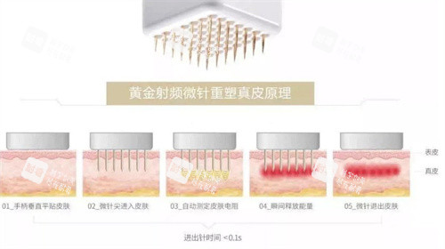 黄金微针原理
