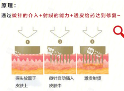 黄金微针原理分析