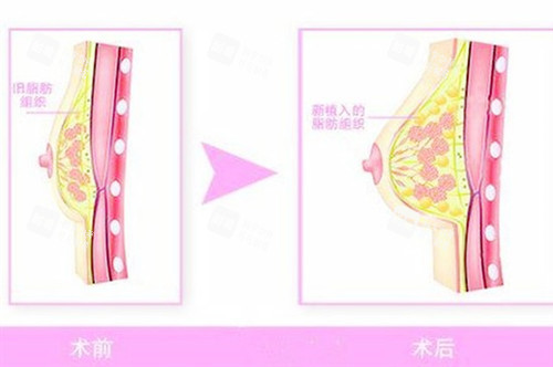自体脂肪隆胸图片
