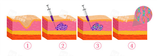 乔雅登HarmonyCA天使针注射变化