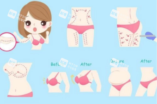 吸脂塑形概念图