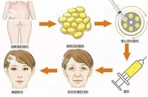 自体脂肪填充过程图解 自体脂肪填充过程图解