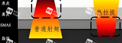 热拉提与普通射频对比 热拉提与普通射频对比