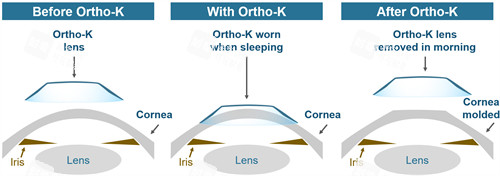 OK镜改善眼睛角膜的弧度 OK镜改善眼睛角膜的弧度
