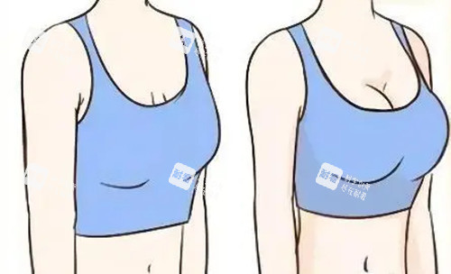 胸部整形前后对比卡通示意图 胸部整形前后对比卡通示意图