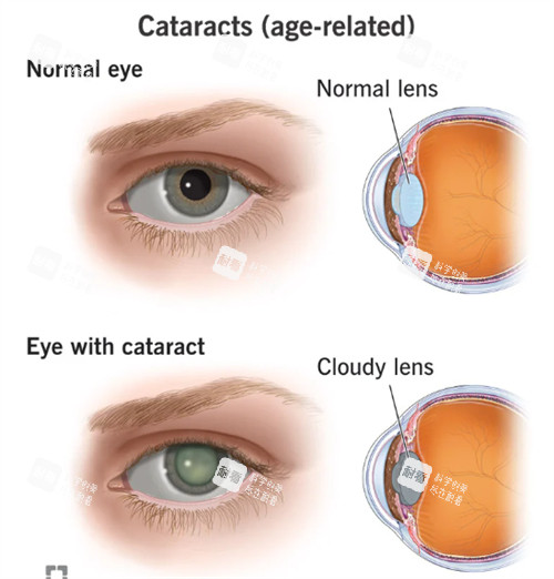 正常眼睛和白内障眼睛