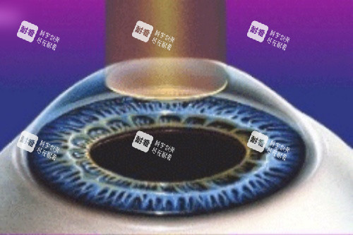 全激光手术 全激光手术