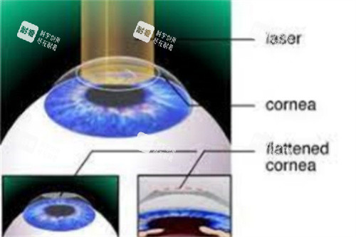 全激光手术示意图 全激光手术示意图