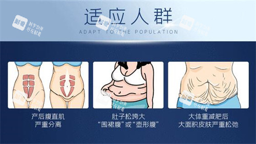 腹壁成形手术适合的人群