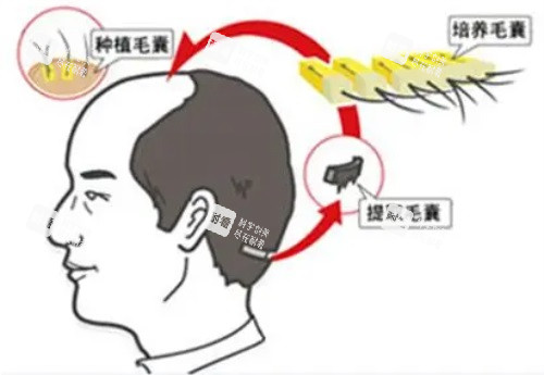 植发提取毛囊示意图