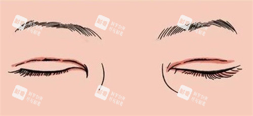 双眼皮疤痕修复