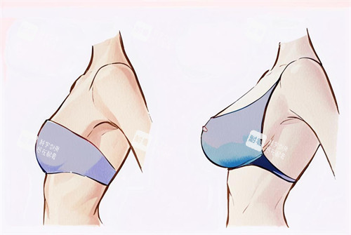 假体隆胸的前后对比图