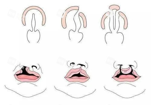 唇腭裂外形卡通示意图