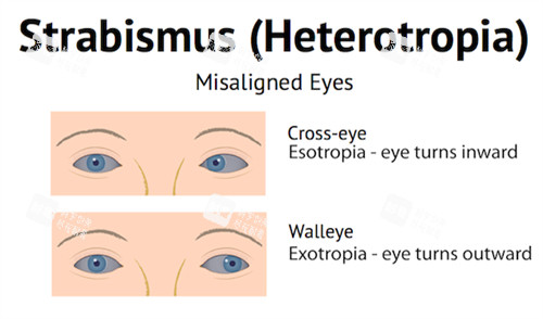 正常眼睛和斜视眼睛对比 正常眼睛和斜视眼睛对比