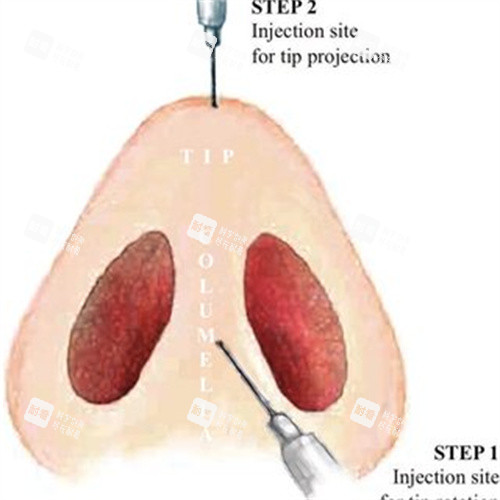 注射隆鼻示意图 注射隆鼻示意图