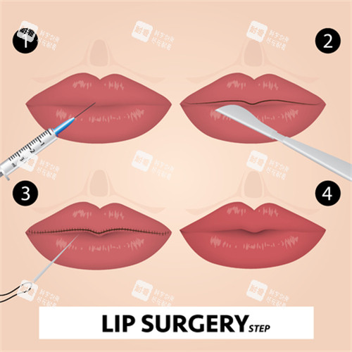 注射丰唇展示图 注射丰唇展示图