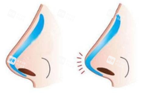 假体隆鼻示意图 假体隆鼻示意图