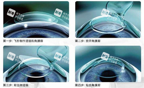 飞秒手术3.0 飞秒手术3.0