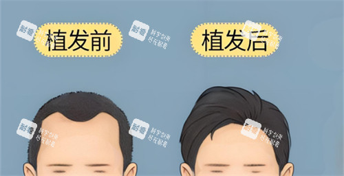 植发