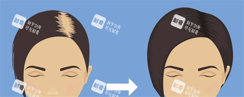 女性毛发移植对比动画图