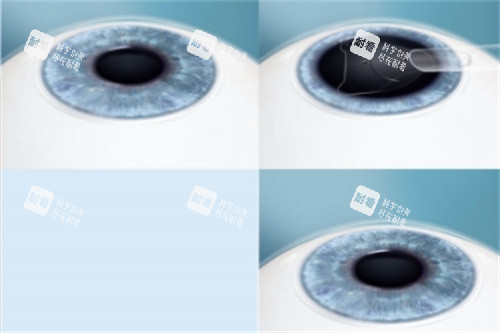 ICL晶体植入手术过程图