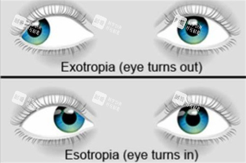 内外斜视