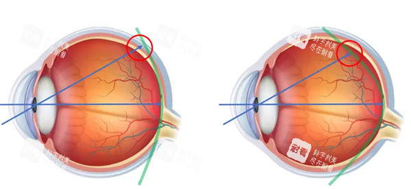 近视眼镜卡通对比
