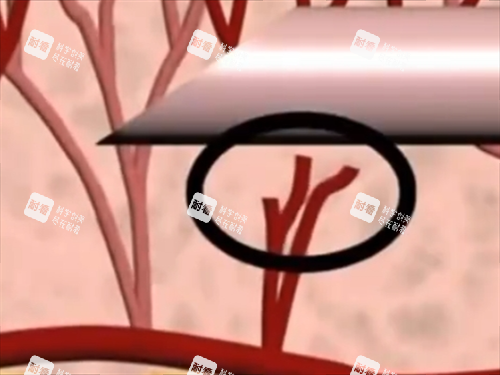 玻尿酸注射内部血管细节展示