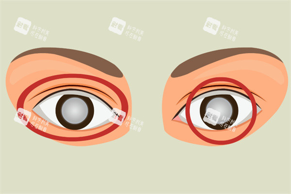 白内障卡通图片展示