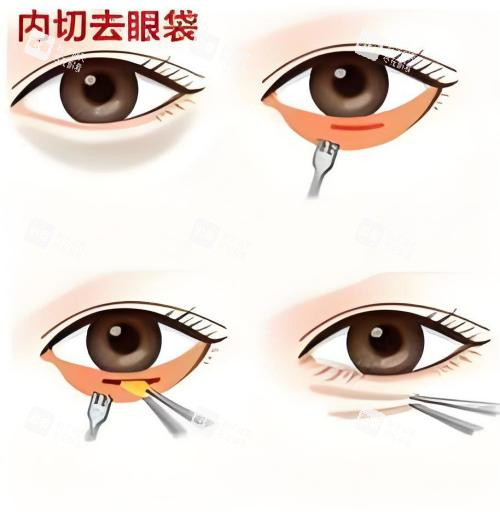 内切去眼袋演示动画图