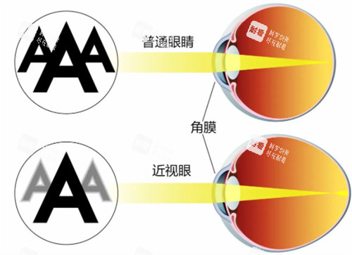 近视眼镜与正常眼睛视物区别