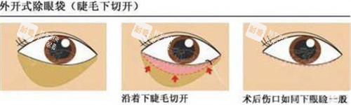外切法祛眼袋手术步骤